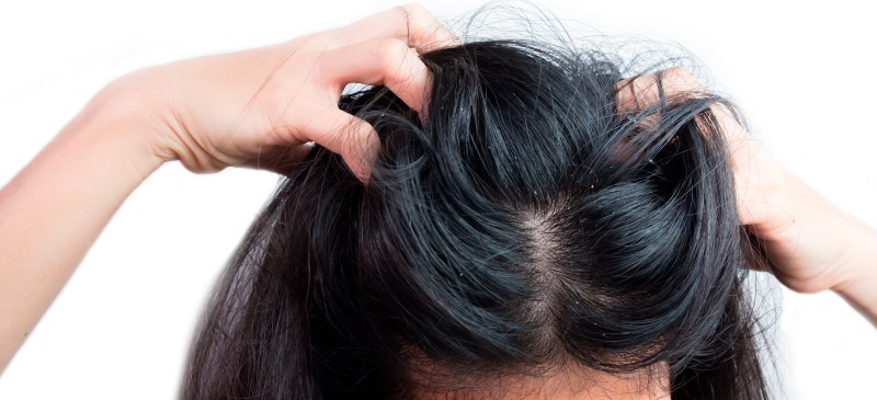 How to Get Rid of Dandruff: 10 Natural Remedies
