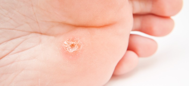How to Get Rid of Warts Naturally