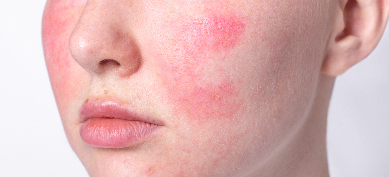 Rosacea Treatment: 6 Natural Ways to Treat Your Skin